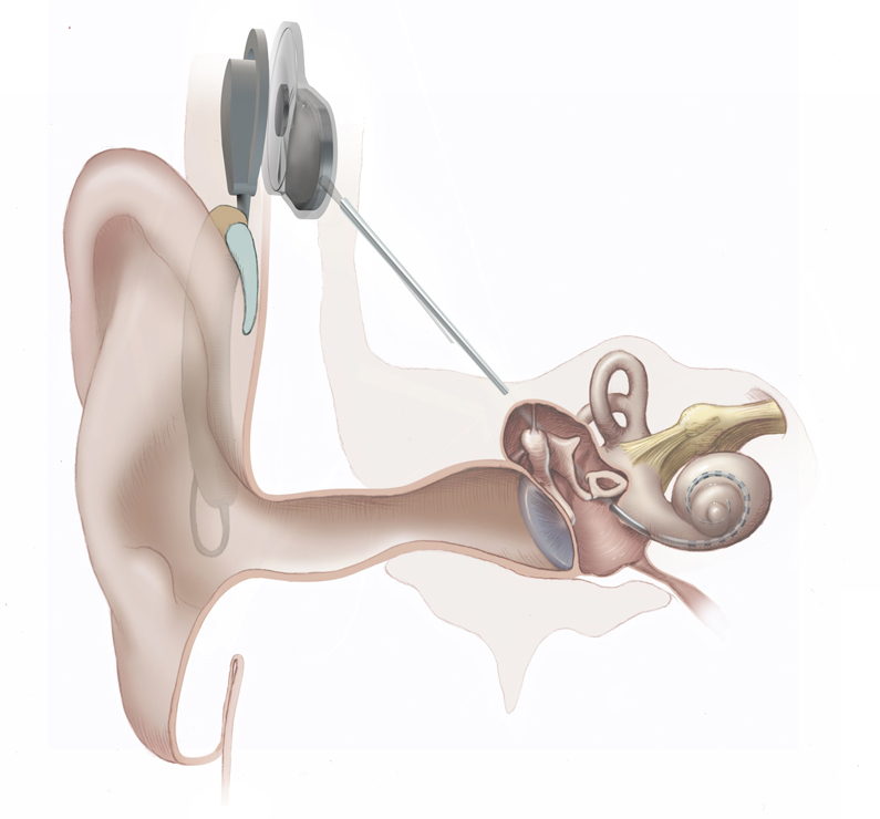 Graphic of a cochlear implant